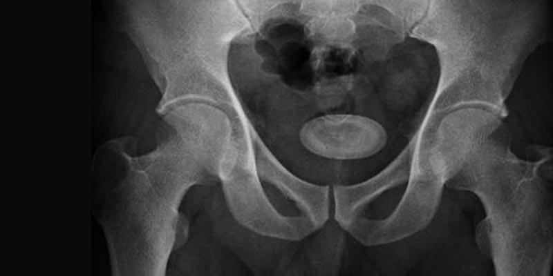 Bladder Stone Treatment Specialist in Dubai