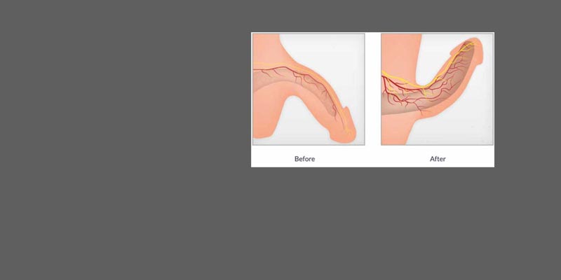 Erectile Dysfunction Treatment in Dubai, Erectile Dysfunction Specialist in Dubai