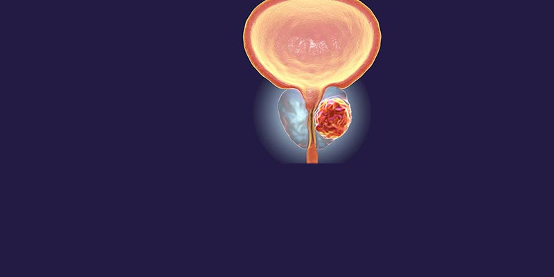 Best Prostate Cancer Treatment