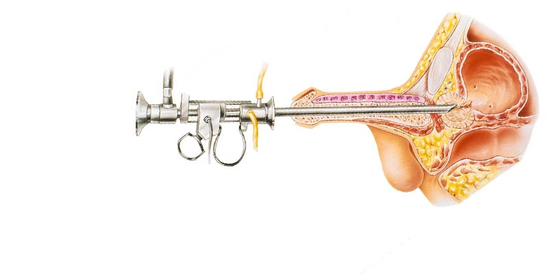 Prostate Laser Surgery