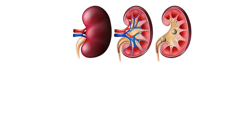 Kidney Stone Treatment In Dubai