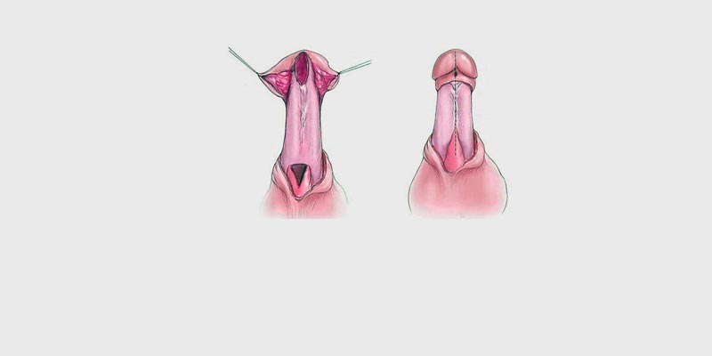 Best Surgeon for Urethroplasty